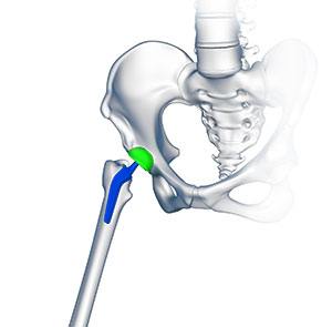 Custom/Patient-Specific Hip Replacement